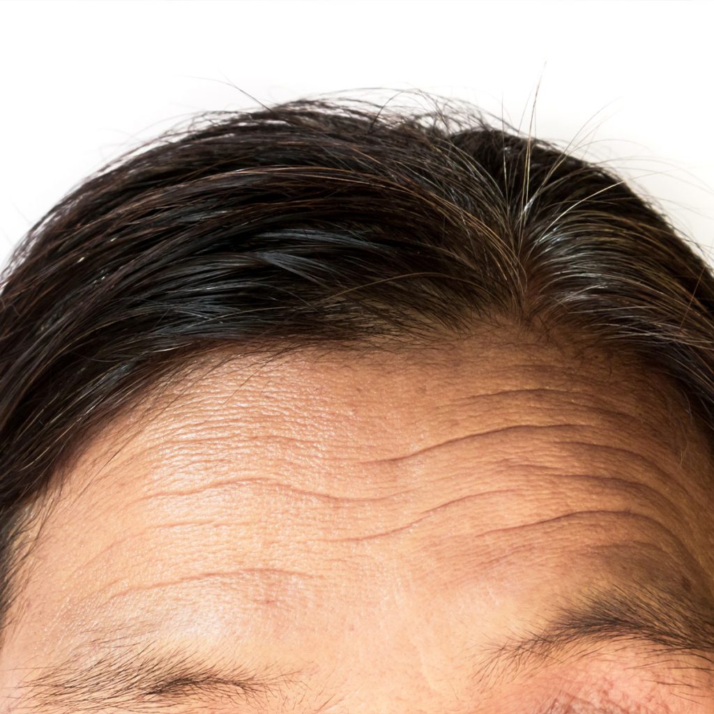 forehead wrinkle filler