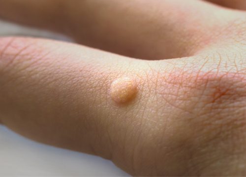 Warts